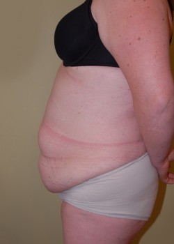Before Image: Tummy Tuck with Liposuction - other
