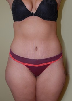 After Image: Tummy Tuck with Liposuction - front