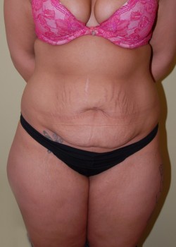 Before Image: Tummy Tuck with Liposuction - front