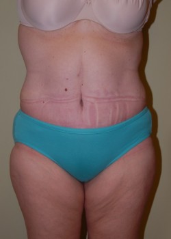 After Image: Tummy Tuck with Liposuction - front