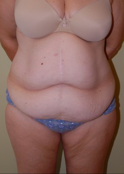 Before Image: Tummy Tuck with Liposuction - front