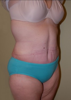 After Image: Tummy Tuck with Liposuction - right-front-oblique
