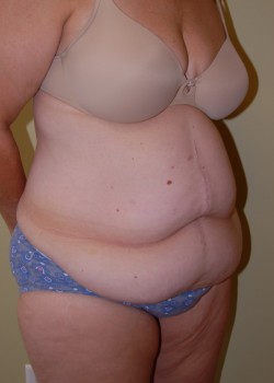 Before Image: Tummy Tuck with Liposuction - right-front-oblique