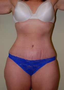 After Image: Tummy Tuck - front