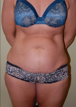 Before Image: Tummy Tuck - front