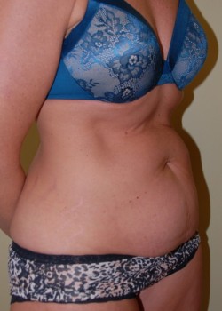 Before Image: Tummy Tuck - right-front-oblique