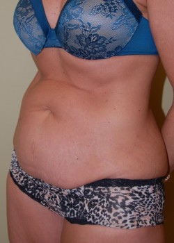 Before Image: Tummy Tuck - left-front-oblique