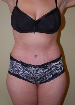 After Image: Tummy Tuck - front
