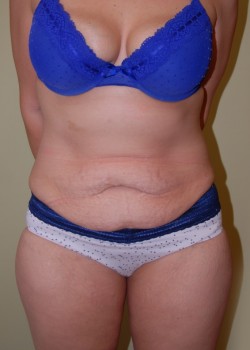 Before Image: Tummy Tuck - front