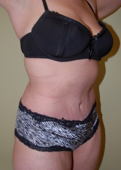 After Image: Tummy Tuck - right-front-oblique