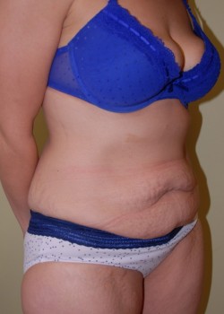 Before Image: Tummy Tuck - right-front-oblique