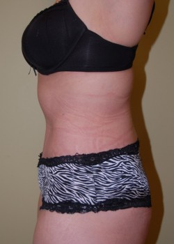 After Image: Tummy Tuck - other