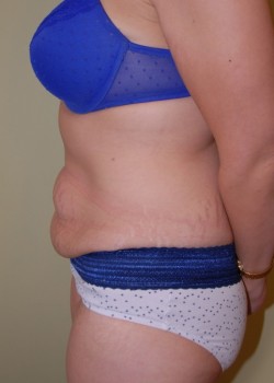 Before Image: Tummy Tuck - other