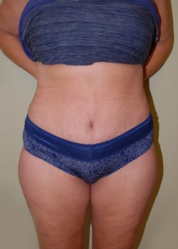 After Image: Tummy Tuck with Liposuction - front