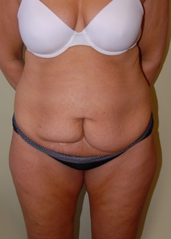 Before Image: Tummy Tuck with Liposuction - front