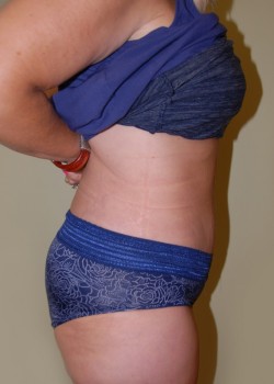 After Image: Tummy Tuck with Liposuction - other