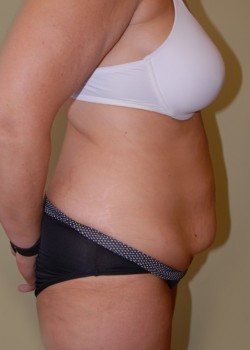 Before Image: Tummy Tuck with Liposuction - other
