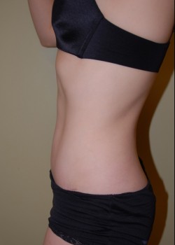 After Image: Tummy Tuck - other