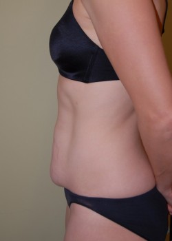 Before Image: Tummy Tuck - other