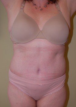 After Image: Tummy Tuck with Liposuction - front