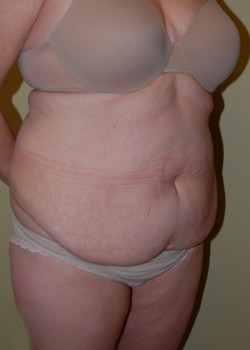 Before Image: Tummy Tuck with Liposuction - right-front-oblique