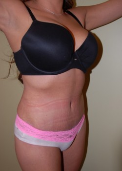 After Image: Tummy Tuck - right-front-oblique