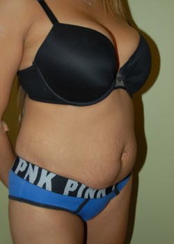 Before Image: Tummy Tuck - right-front-oblique