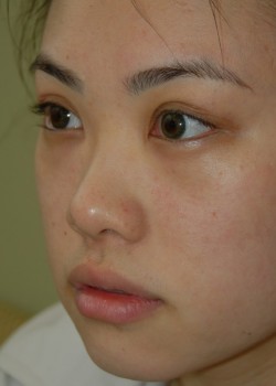 After Image: Asian Double Eyelid - left-front-oblique