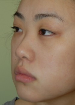Before Image: Asian Double Eyelid - left-front-oblique