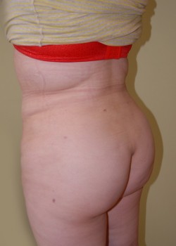 After Image: Brazilian Butt Lift - left-front-oblique