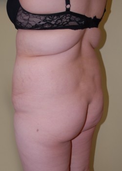 Before Image: Brazilian Butt Lift - left-front-oblique