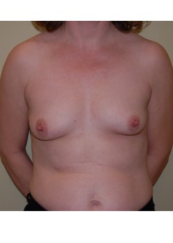 Before Image: Breast Augmentation - front