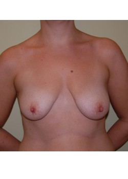 Before Image: Breast Lift with Implants - front
