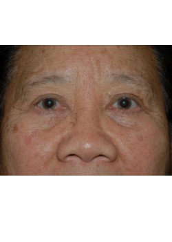 After Image: Upper and Lower Eyelid Surgery - front