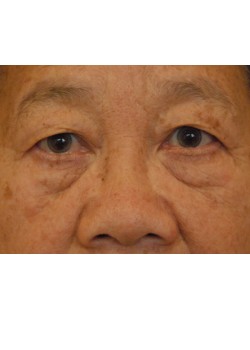 Before Image: Upper and Lower Eyelid Surgery - front