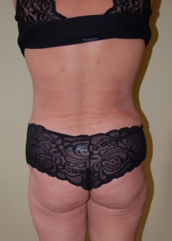 After Image: Liposuction Back and Love Handles - front