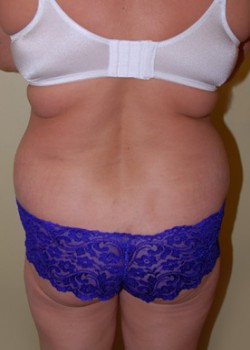 Before Image: Liposuction Back and Love Handles - front