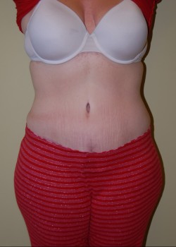 After Image: Tummy Tuck, Liposuction - front