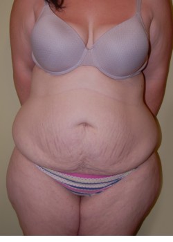 Before Image: Tummy Tuck, Liposuction - front