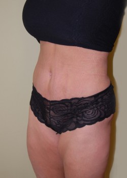 After Image: Tummy Tuck, Liposuction - left-front-oblique
