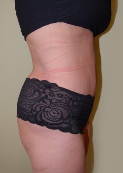 After Image: Tummy Tuck, Liposuction - other