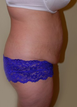 Before Image: Tummy Tuck, Liposuction - other