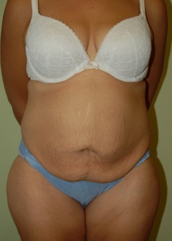 Before Image: Tummy Tuck - front