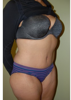 After Image: Tummy Tuck - right-front-oblique