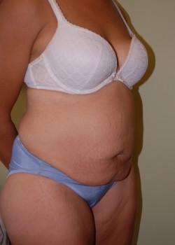 Before Image: Tummy Tuck - right-front-oblique