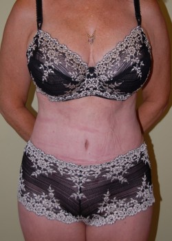 After Image: Tummy Tuck, Liposuction - front