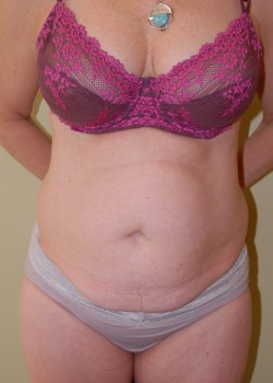 Before Image: Tummy Tuck, Liposuction - front