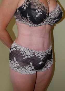 After Image: Tummy Tuck, Liposuction - right-front-oblique