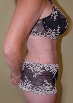 After Image: Tummy Tuck, Liposuction - other