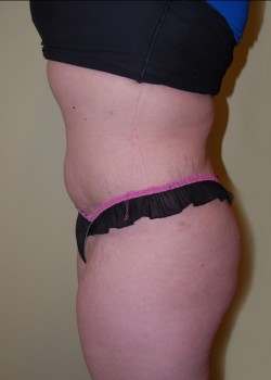 After Image: Tummy Tuck, Liposuction - other